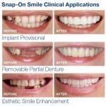 لمینت دندان اسنپ ان اسمایل - Image 3