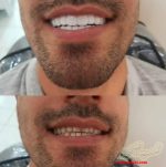 لمینت دندان اسنپ ان اسمایل - Image 7