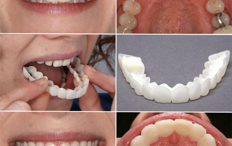 لمینت دندان اسنپ ان اسمایل تک فک
