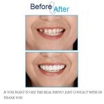 لمینت دندان اسنپ ان اسمایل تک فک