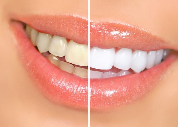 چسب سفید کننده دندان