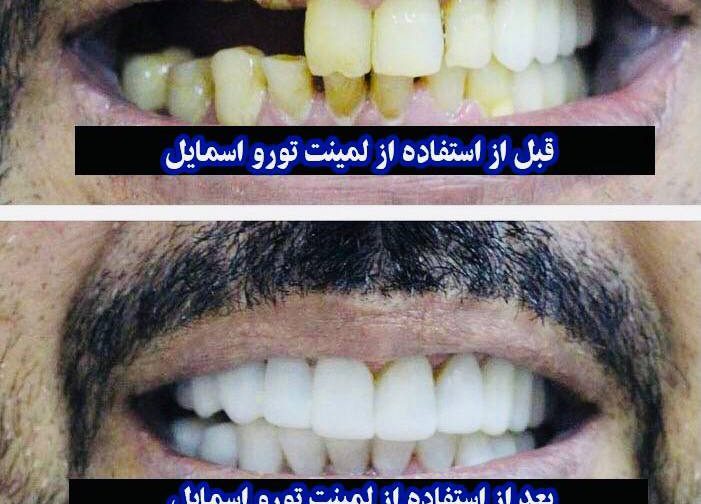 لمینت متحرک ترو اسمایل